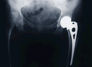 hip-replacement-xray